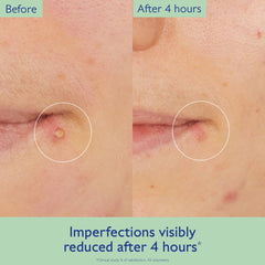 Caudalie Vinopure applied to blemish demonstrating targeted reduction