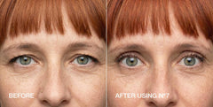 Contours Rx before and after hooded eyelid lift showing symmetry benefit
