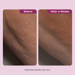 DEKLIDERM used on décolleté to improve crepey chest appearance
