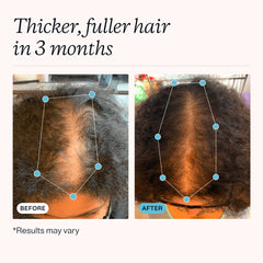 MDhair regrowth serum dropper applying to scalp for targeted benefit