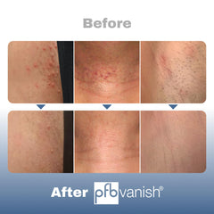 PFB Vanish applied after shave to neck illustrating calming effect and smoother skin