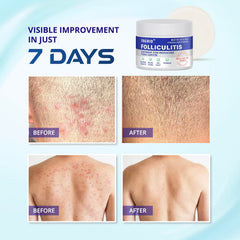 tagrid using cream on face to reduce redness and improve comfort