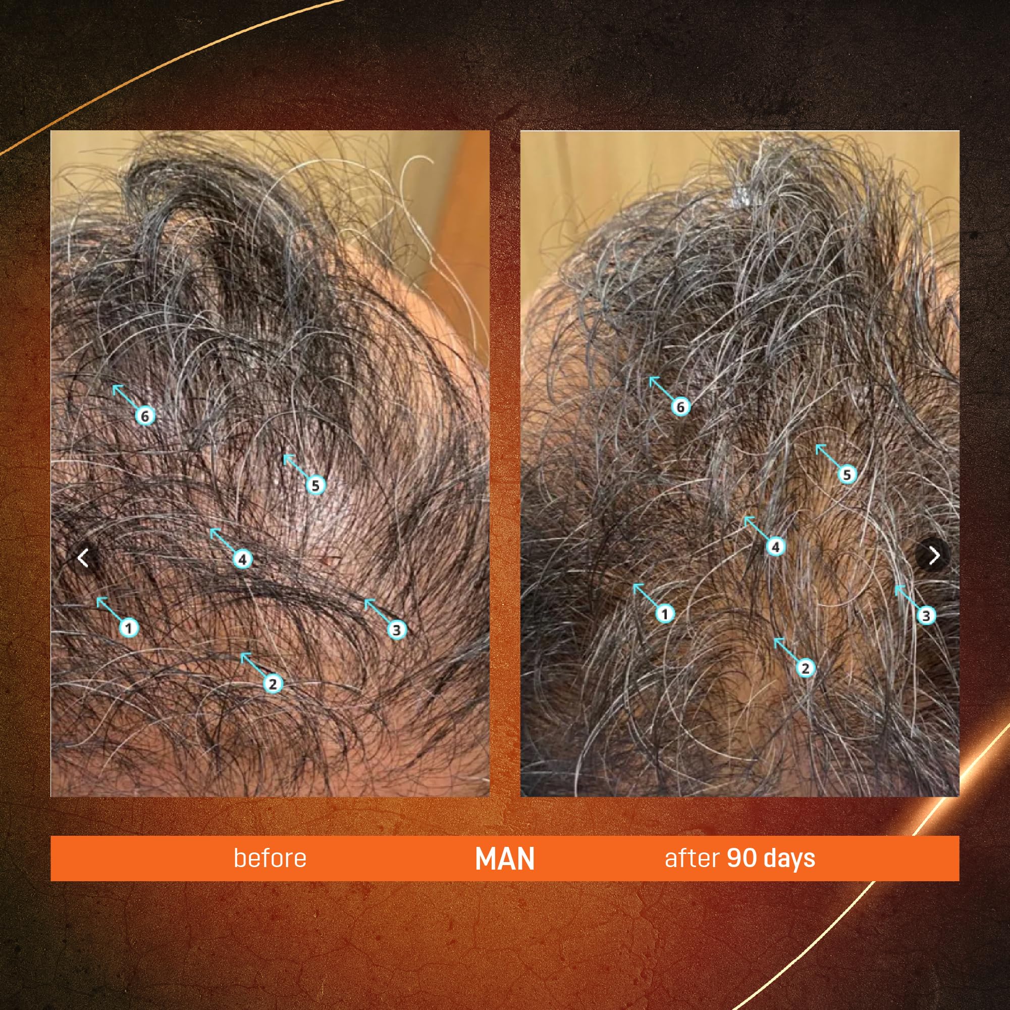 Applying ABERA on scalp along part to support targeted follicle application