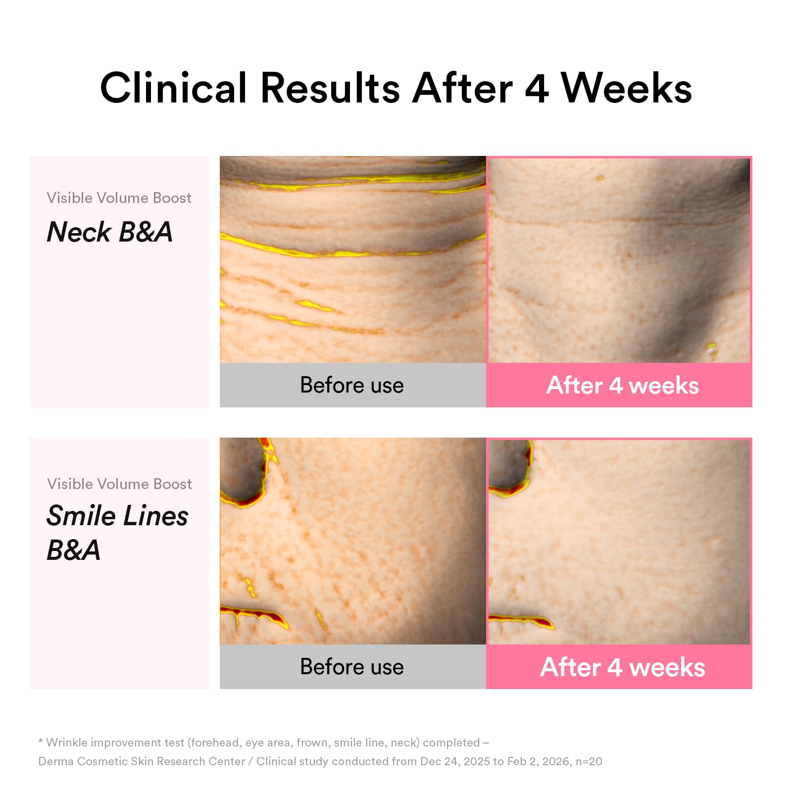 Abib being dabbed into smile lines to help restore facial contour