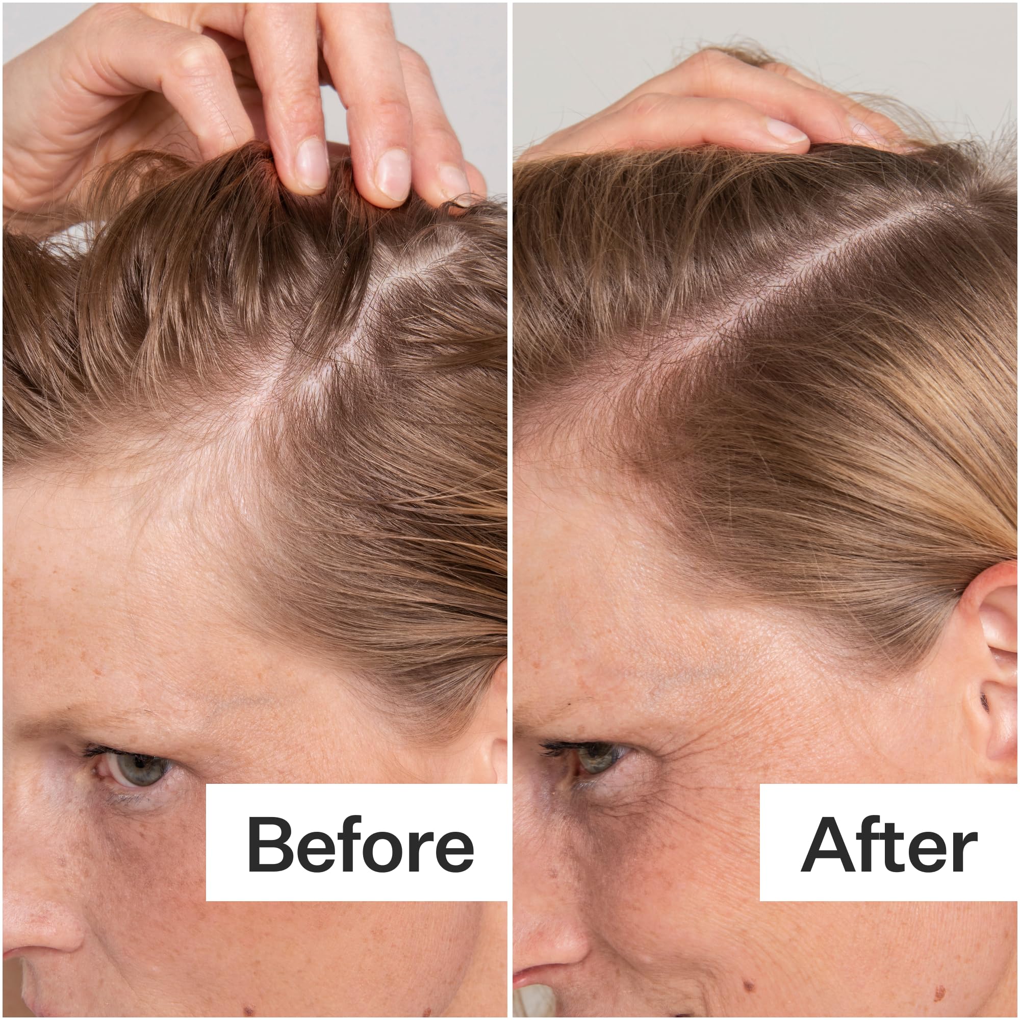 ACT+ ACRE being applied to scalp demonstrating targeted treatment benefit