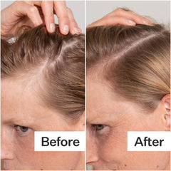 ACT+ ACRE being applied to scalp demonstrating targeted treatment benefit