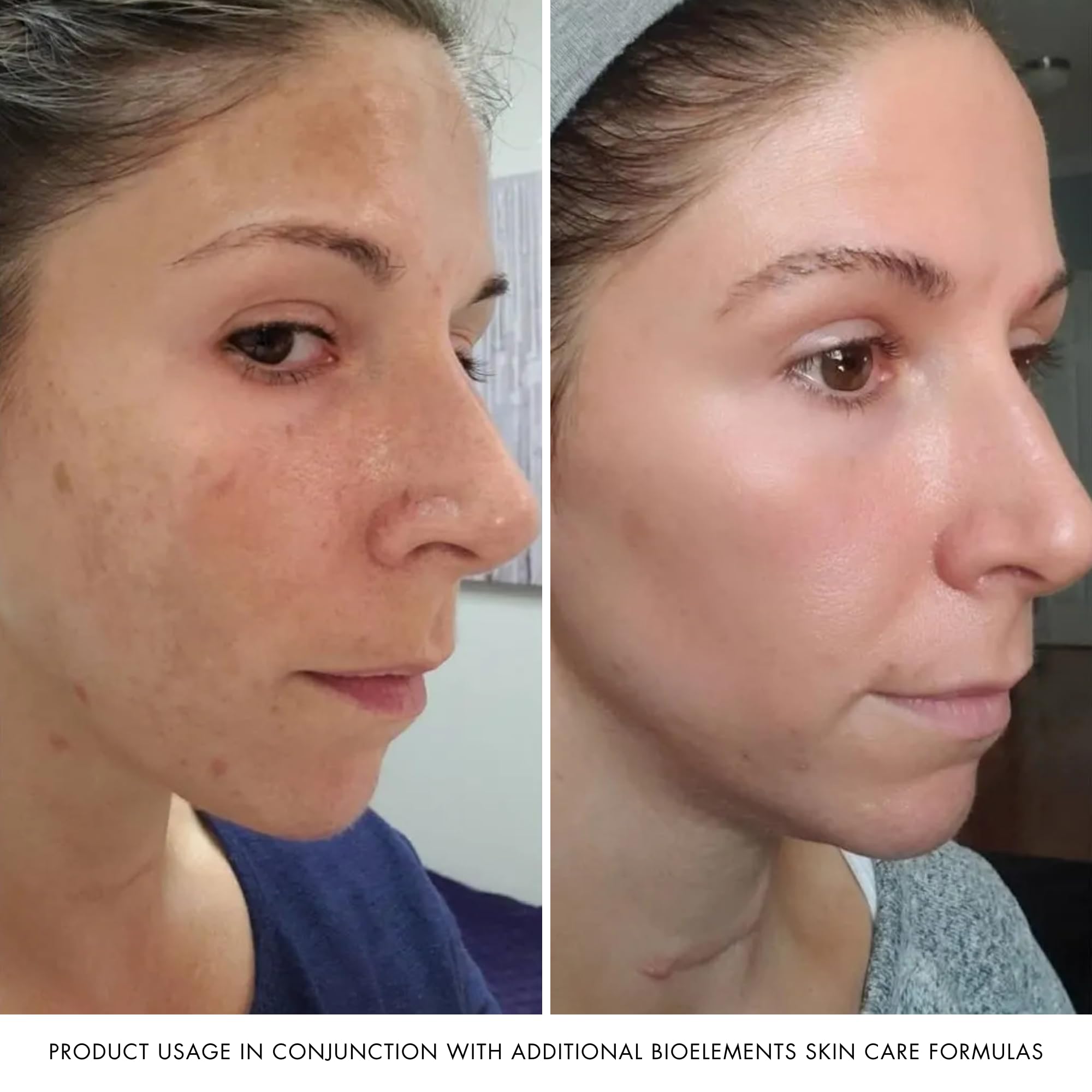 Bioelements t-zone focus showing reduced shine and balanced skin appearance