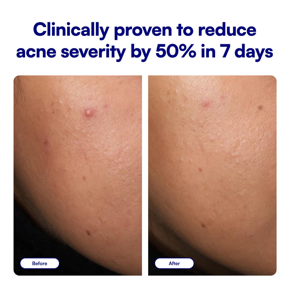 Bliss tube tip dispensing spot treatment for precise, non-greasy application