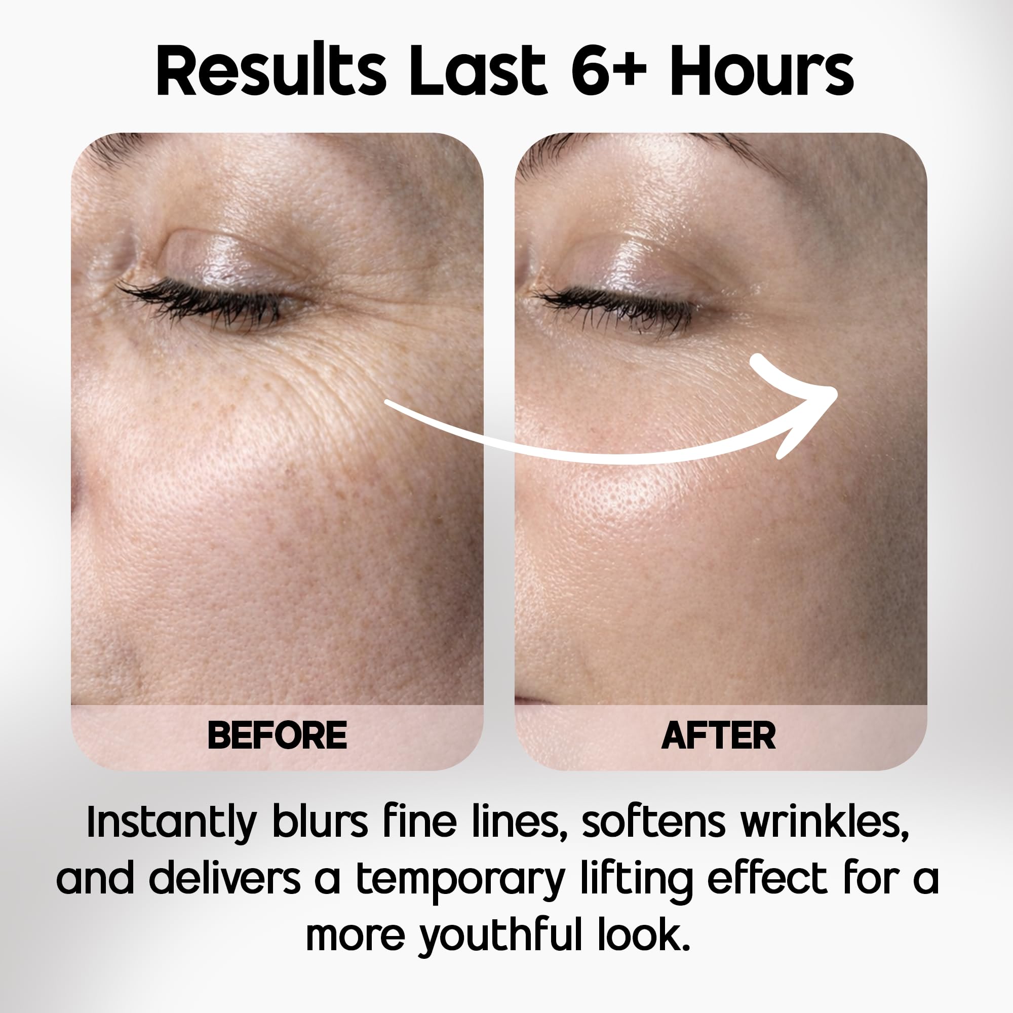 Applying Celestolite at mouth lines to smooth expression wrinkles quickly