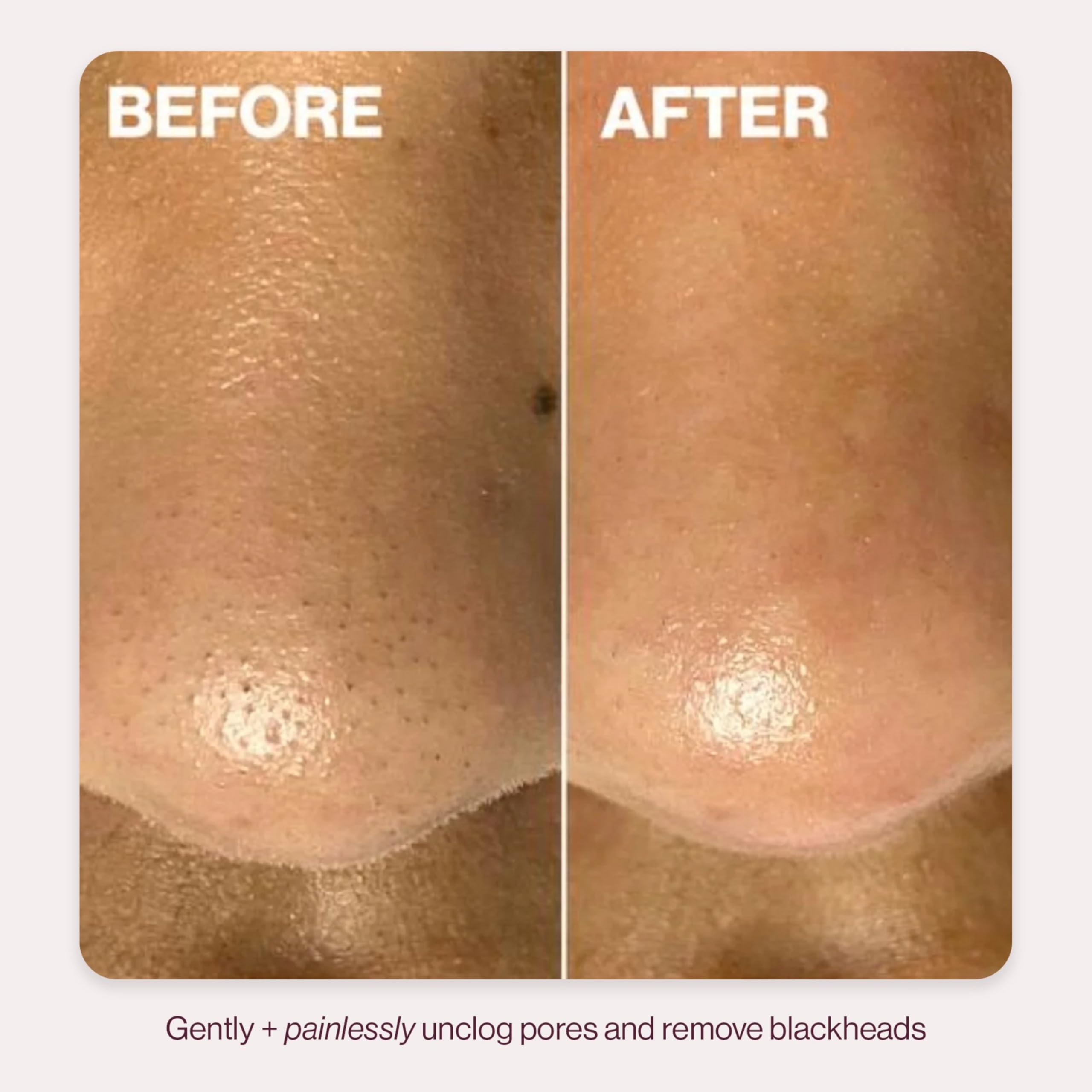 DERMAFLASH full kit flat-lay with USB cord illustrating complete-treatment benefit