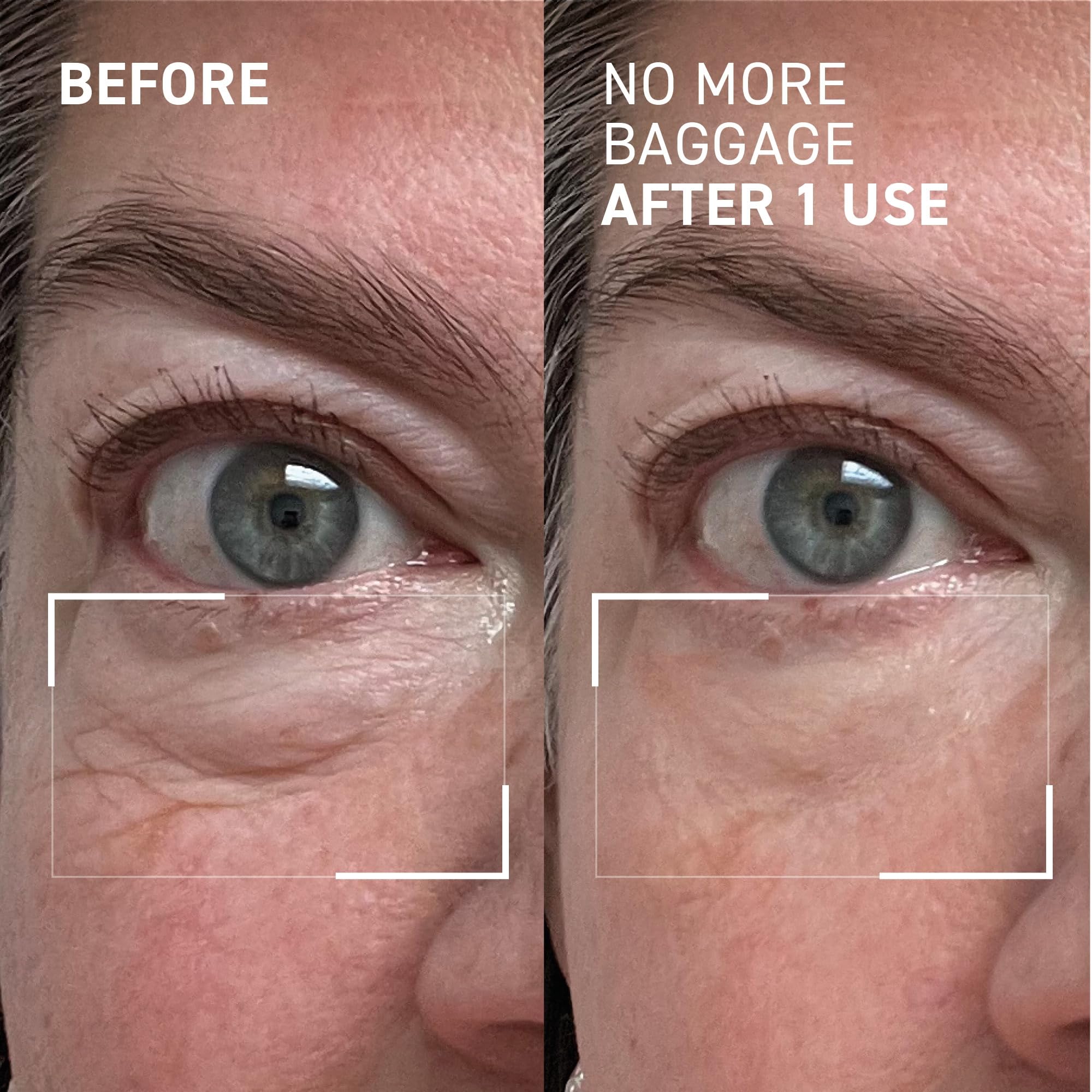 Dr. Brandt before and after comparison showing reduced puffiness and brighter eyes
