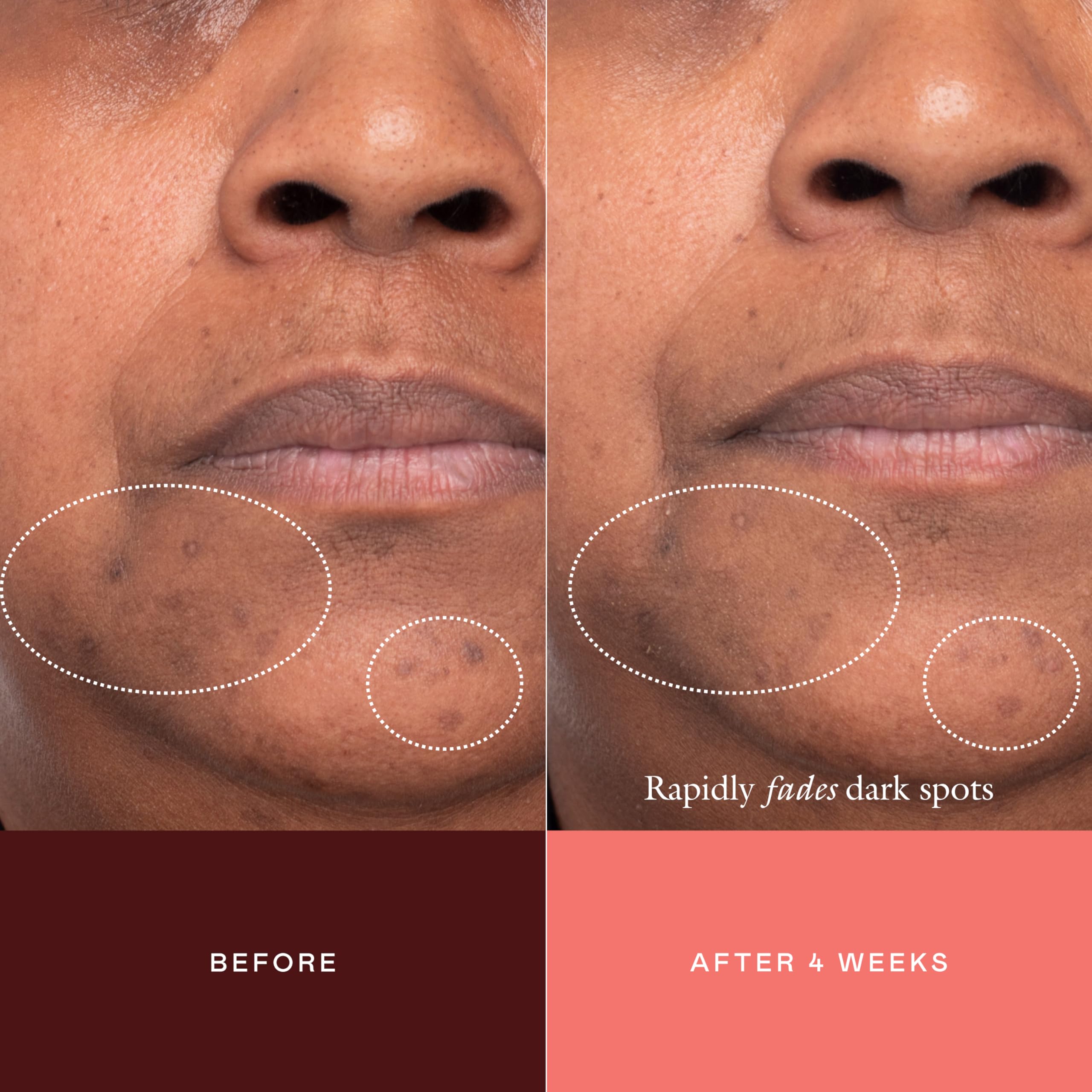 EADEM scale comparison before and after to show visible improvement benefit