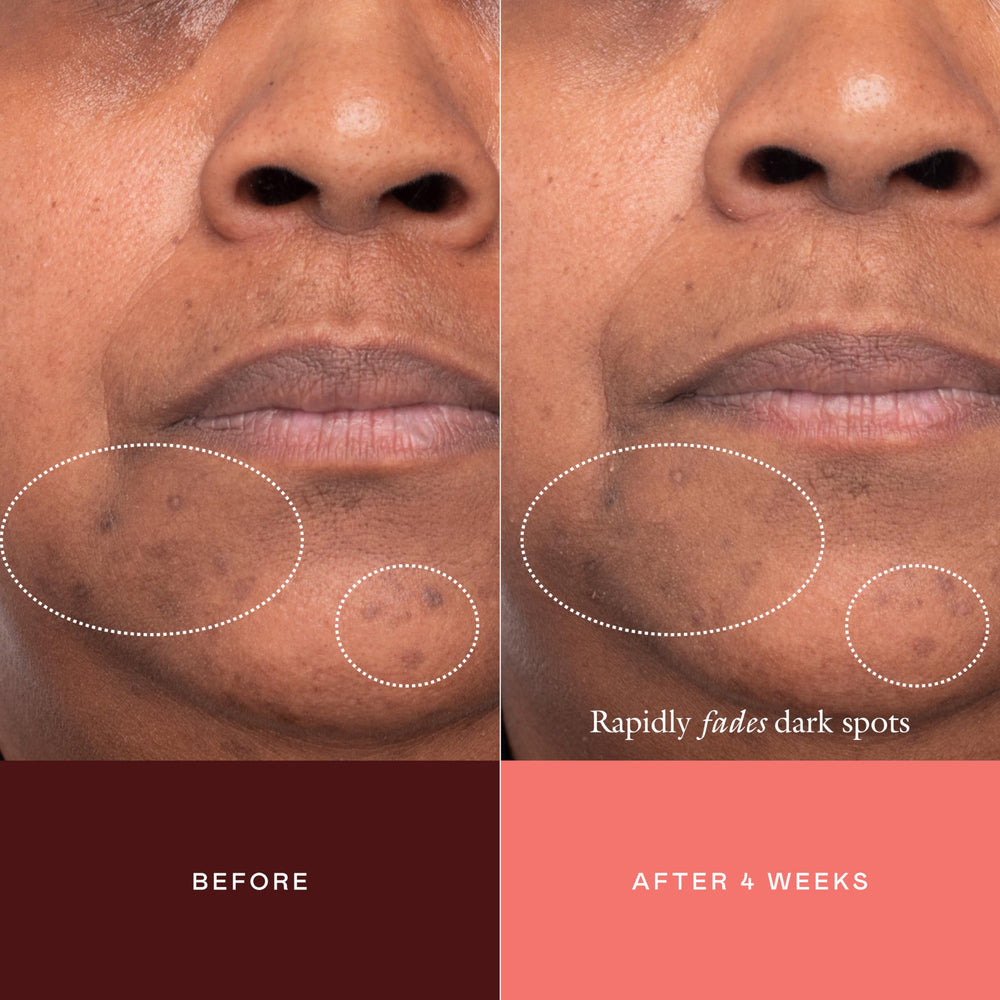 EADEM scale comparison before and after to show visible improvement benefit