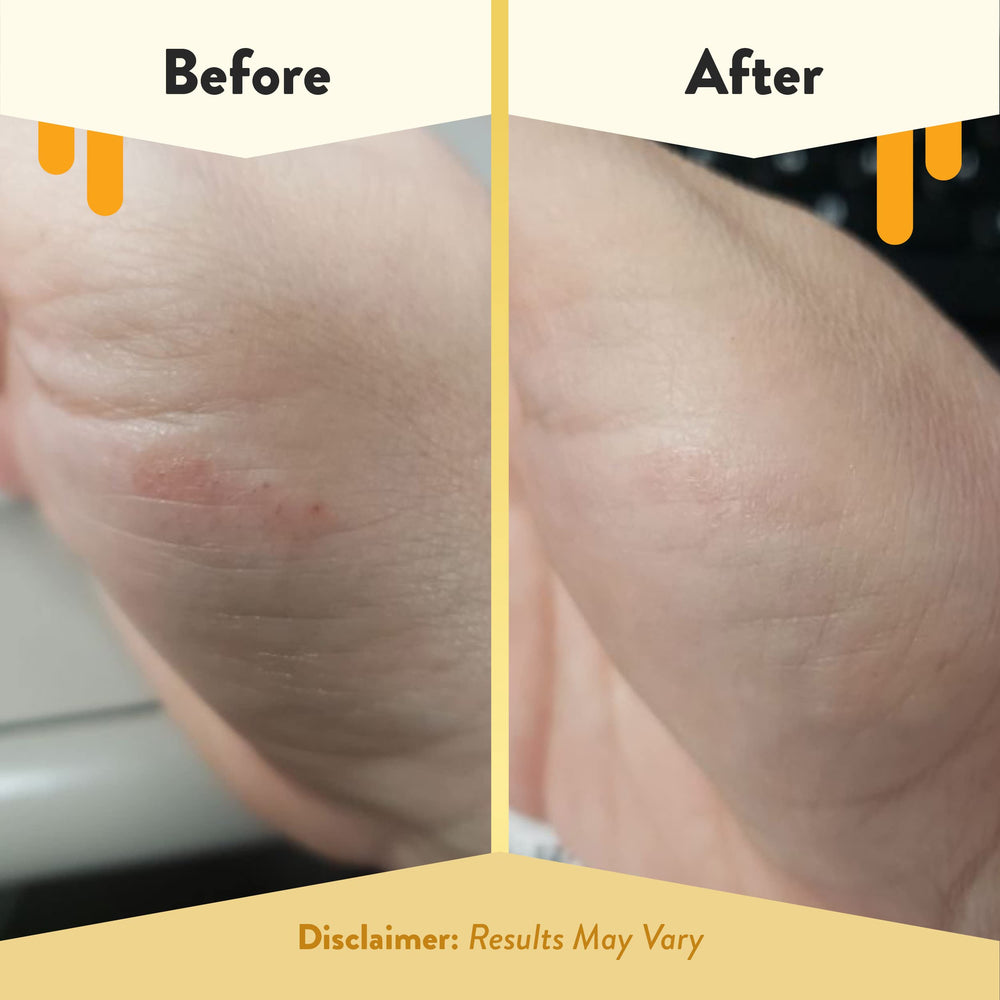 ECZEMA HONEY pad in hand for scale and easy portability benefit