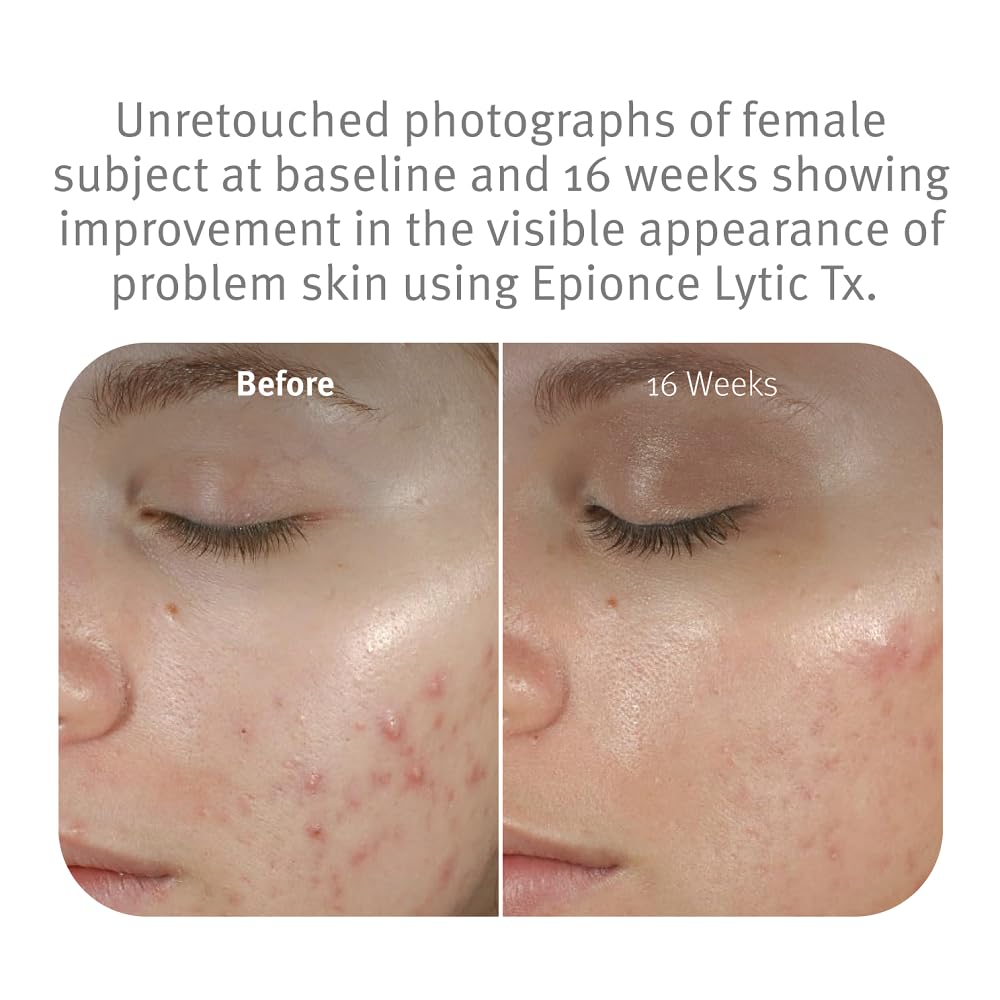 Epionce Lytic Tx being applied to hand demonstrating quick absorption benefit