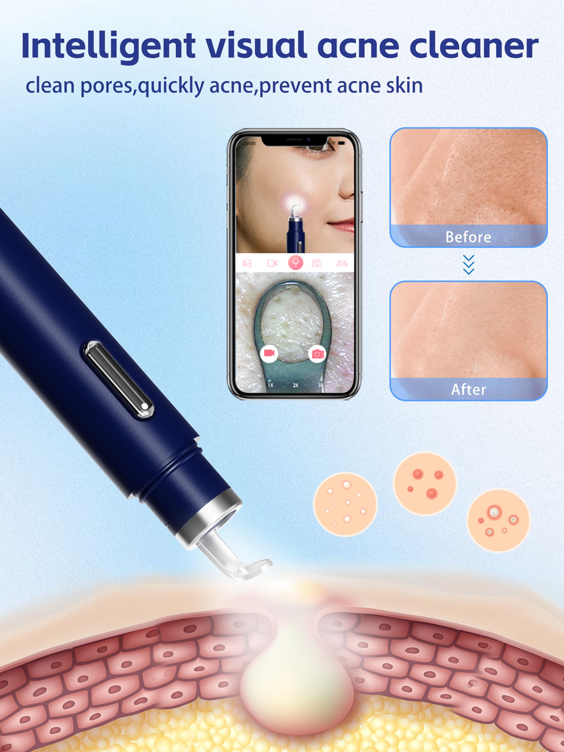 EURART stainless steel double‑ended tools closeup for hygienic, controlled blackhead removal