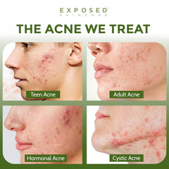 Exposed Skin Care back label close-up showing ingredients and usage directions for confidence