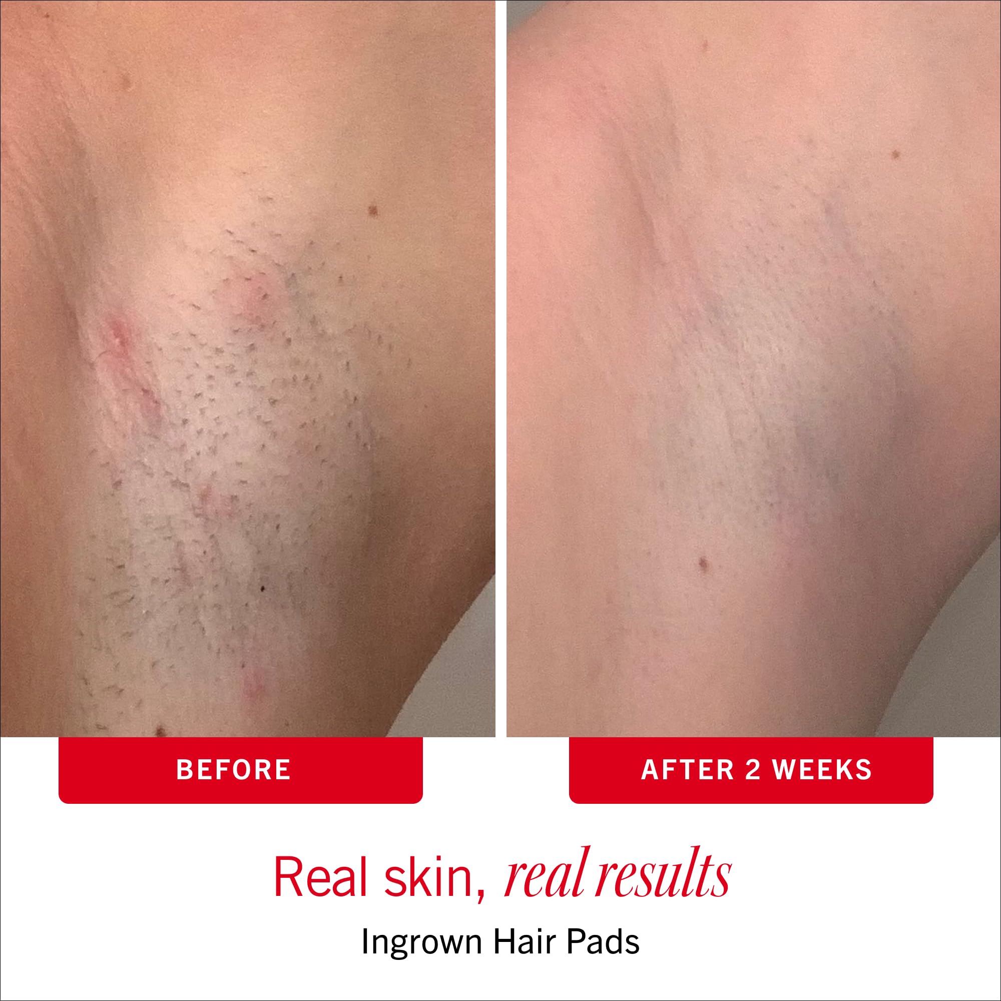 First Aid Beauty ingrown pad used on bikini area reducing razor bumps