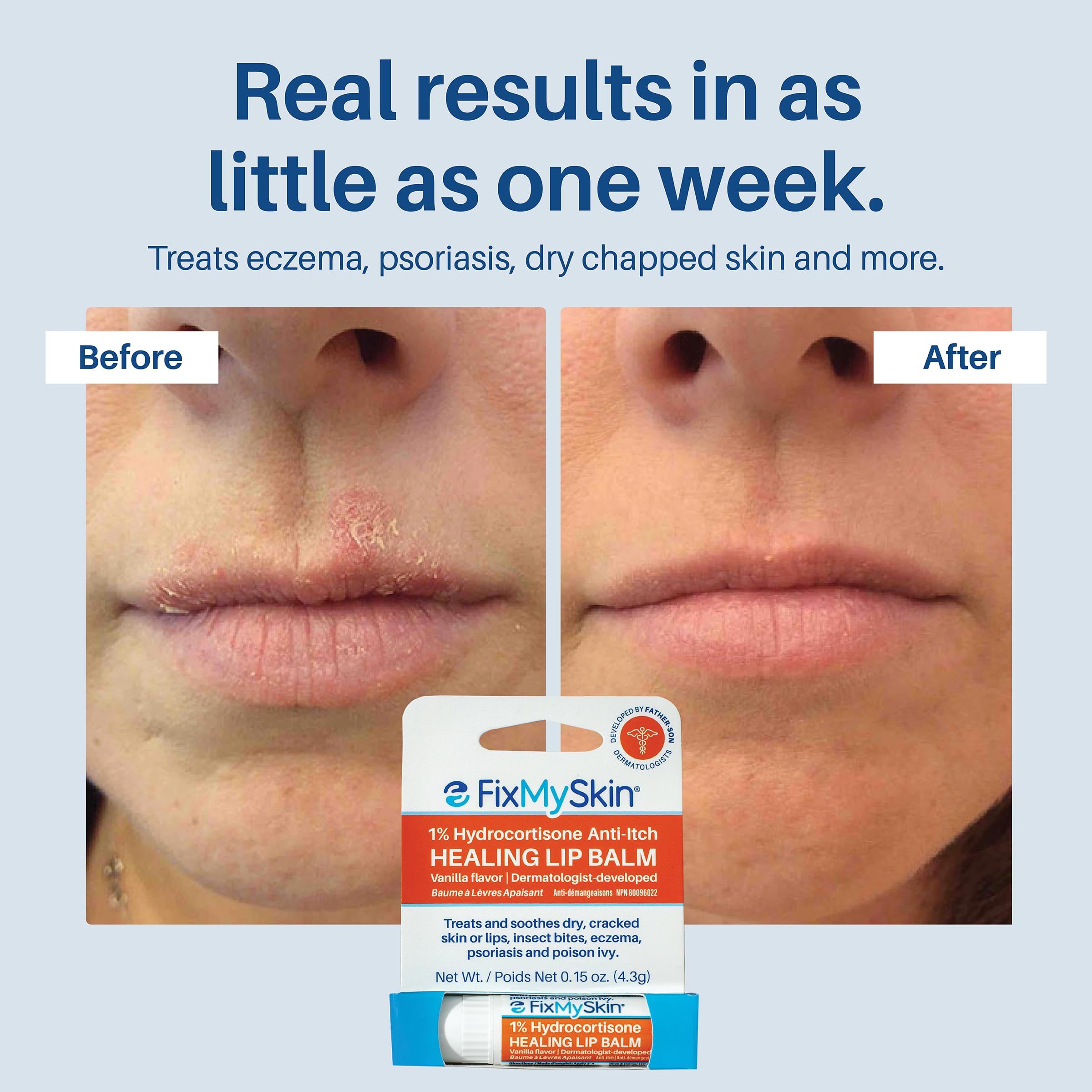 FixMySkin applied to lips demonstrating instant comfort and reduce redness