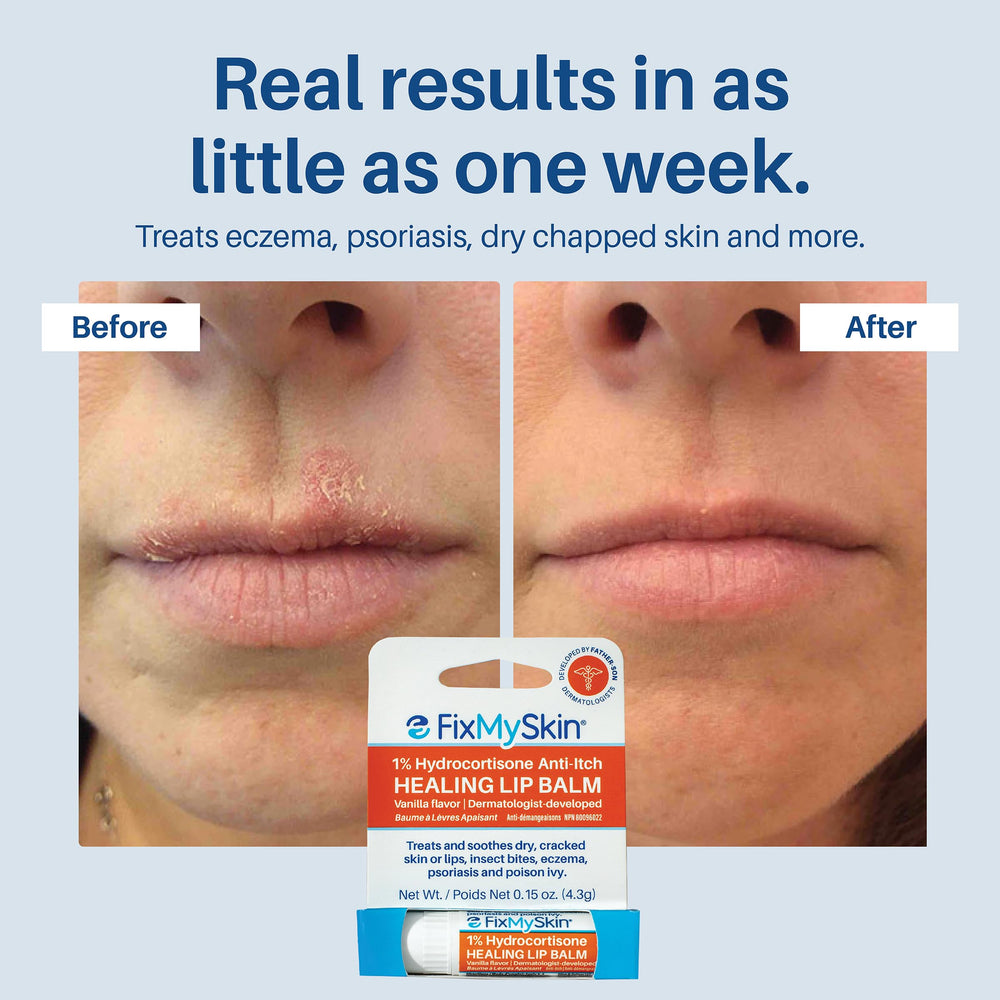 FixMySkin applied to lips demonstrating instant comfort and reduce redness