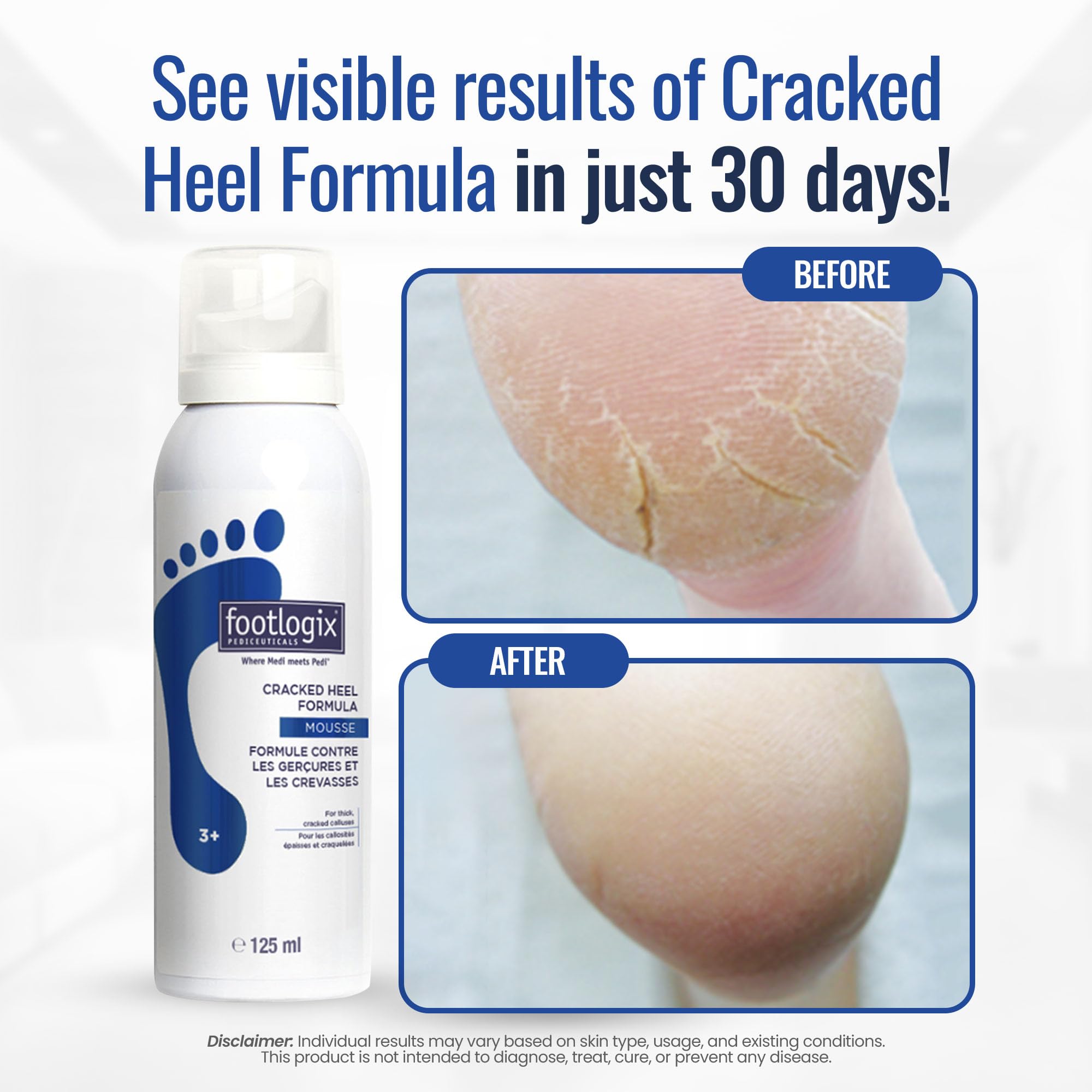 FOOTLOGIX pump dispensing mousse showing easy, measured application