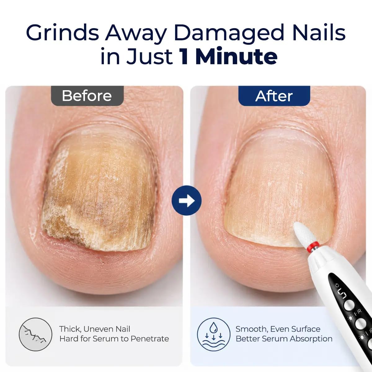 Generic texture close-up showing smoother surfaced thick toenail after filing