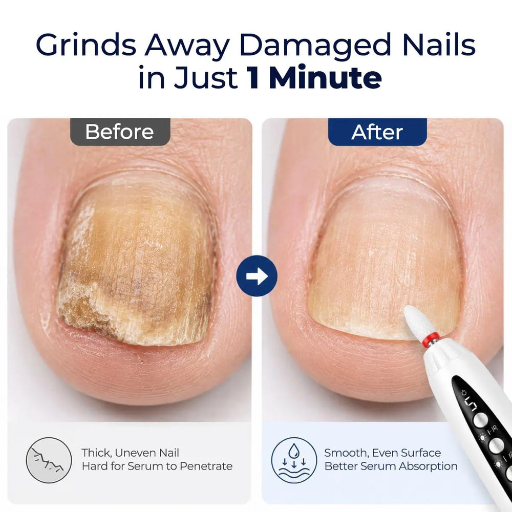 Generic texture close-up showing smoother surfaced thick toenail after filing