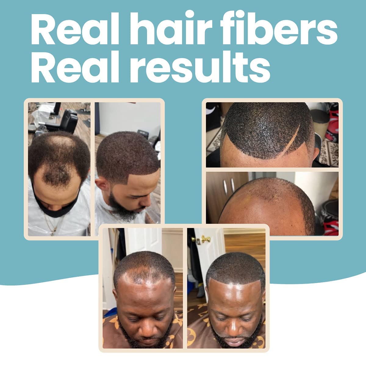 Hair Illusion covering beard scar to create fuller facial hair appearance