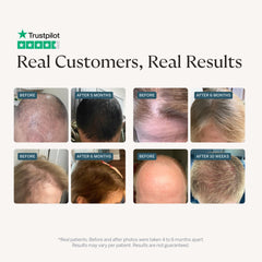 Happy Head dropper applying serum to scalp for precise daily dosing benefit