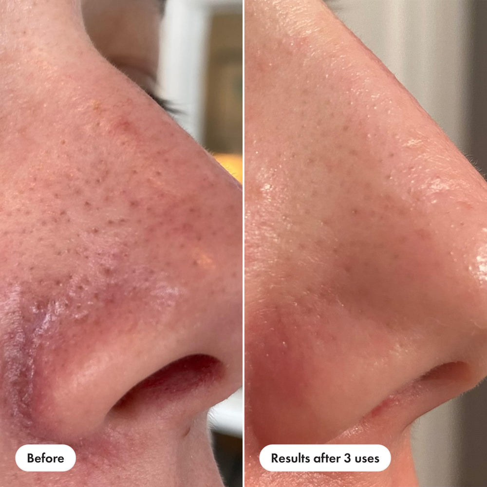 Hero Cosmetics product applied to nose to target blackheads, illustrates targeted use
