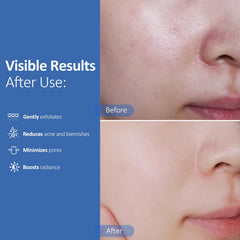 Hicream pad soaked in solution displaying active acids and hydrating ingredients for balanced care