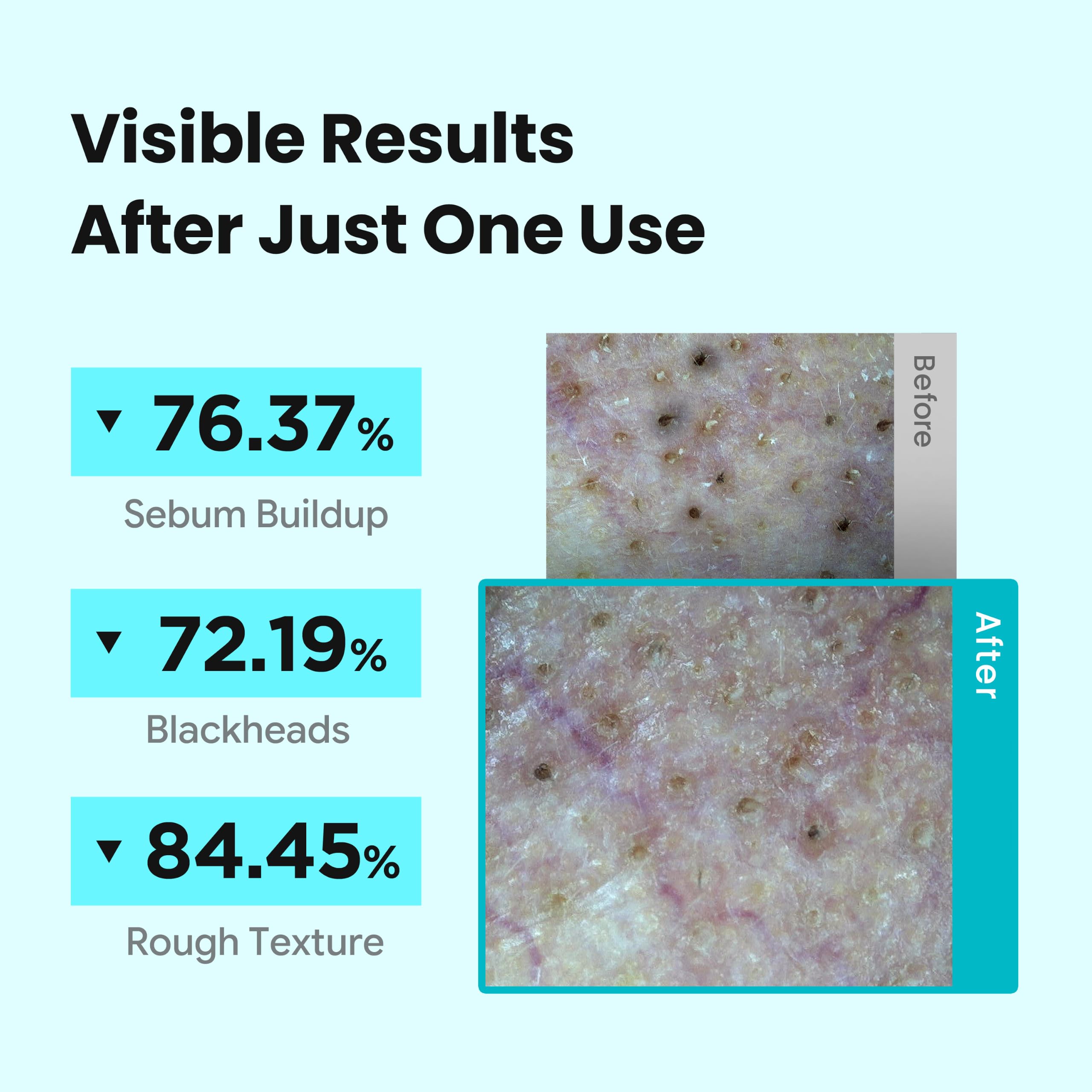 ilso skin wrap pad used on T-zone for targeted pore softening