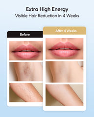 INNZA flash window detail highlighting energy output for effective follicle targeting