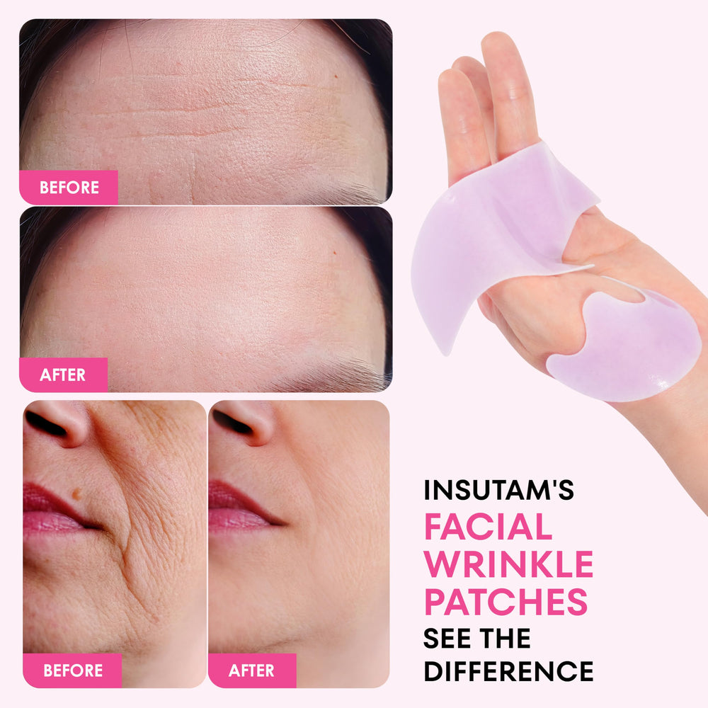 Insutam patch on smile line showing targeted placement and visible crease softening