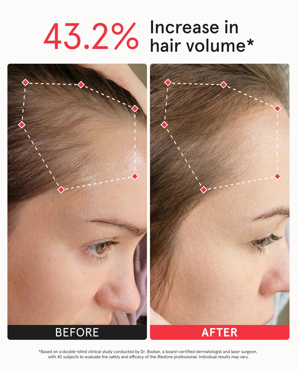 iRestore scale comparison on head showing full-scalp coverage benefit
