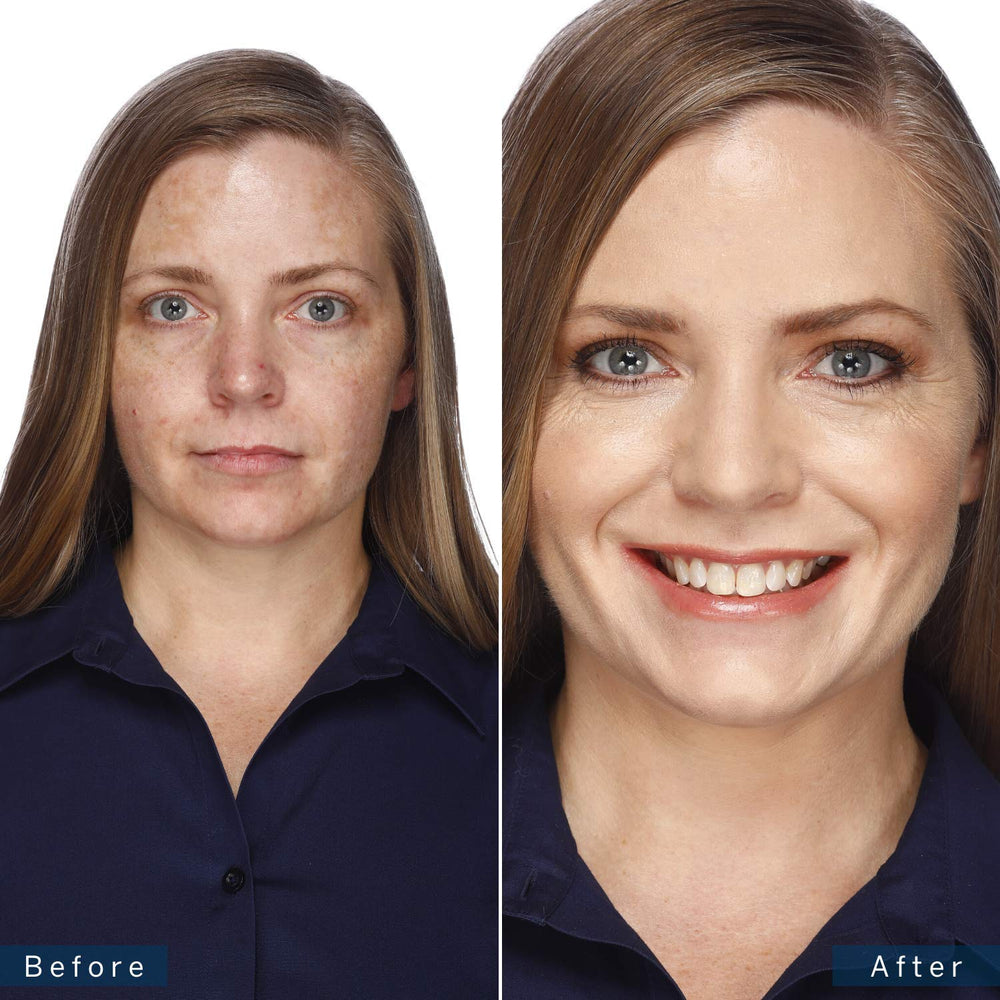 Jerome Alexander before and after cheek showing coverage of discoloration and natural look