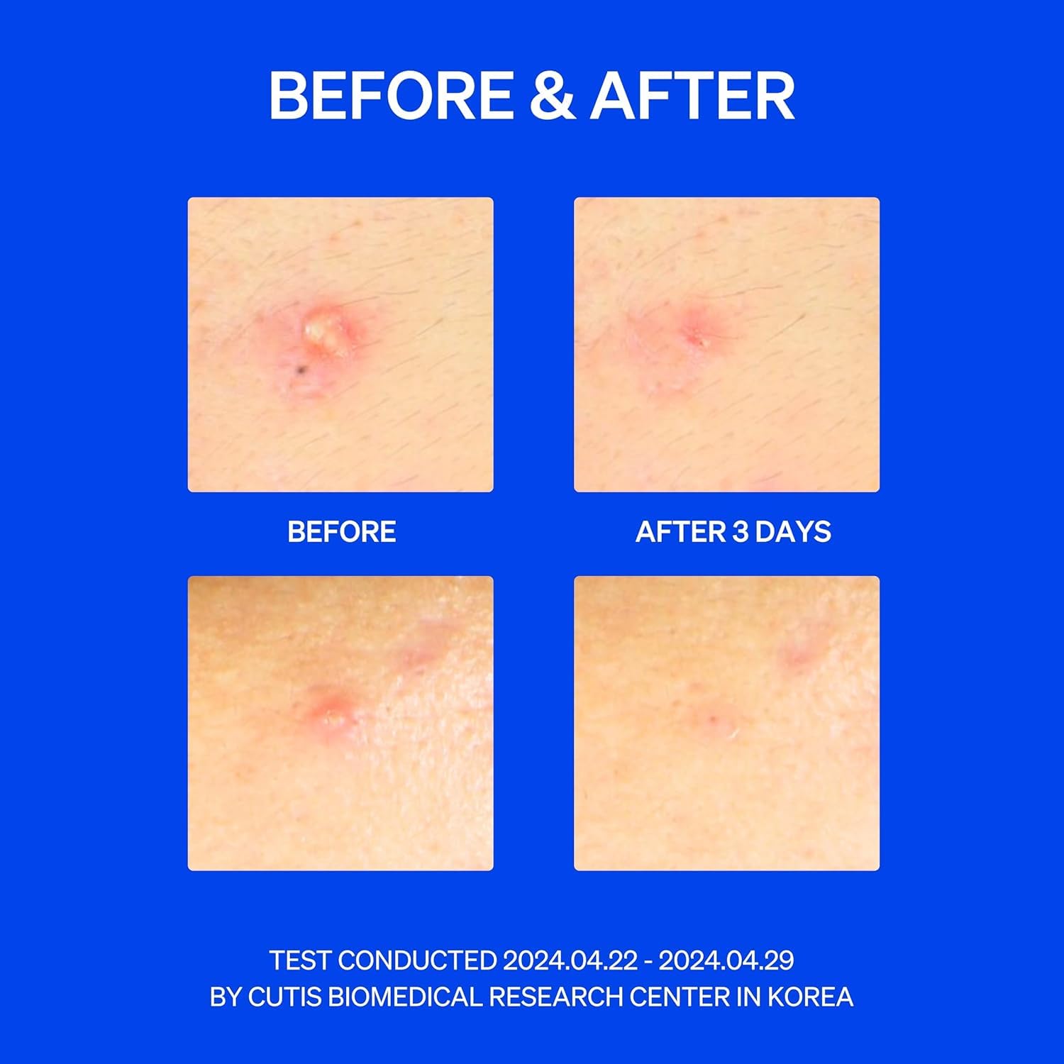KNEMO patch next to coin illustrating two sizes for targeted blemish coverage
