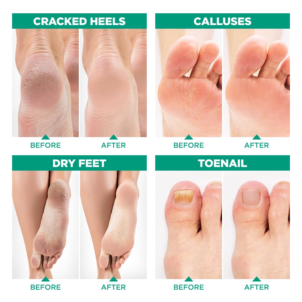 Lavinso callus softening before and after comparison showing smoother heel improvement