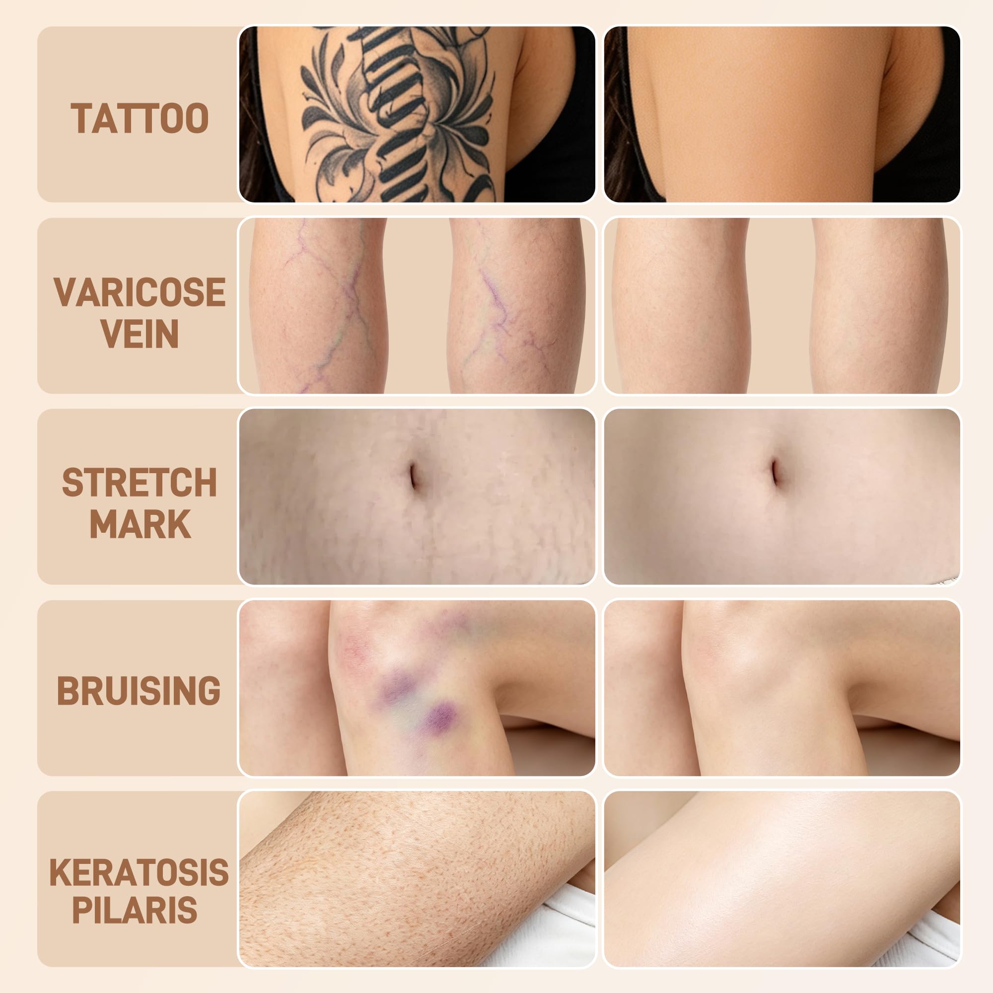 LELB before and after on leg showing effective tattoo concealment benefit