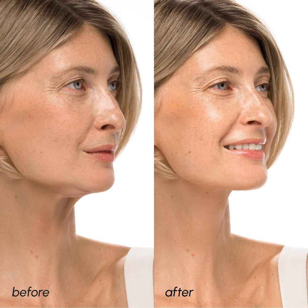 MAREE applied under chin illustrating targeted lift and jawline shaping