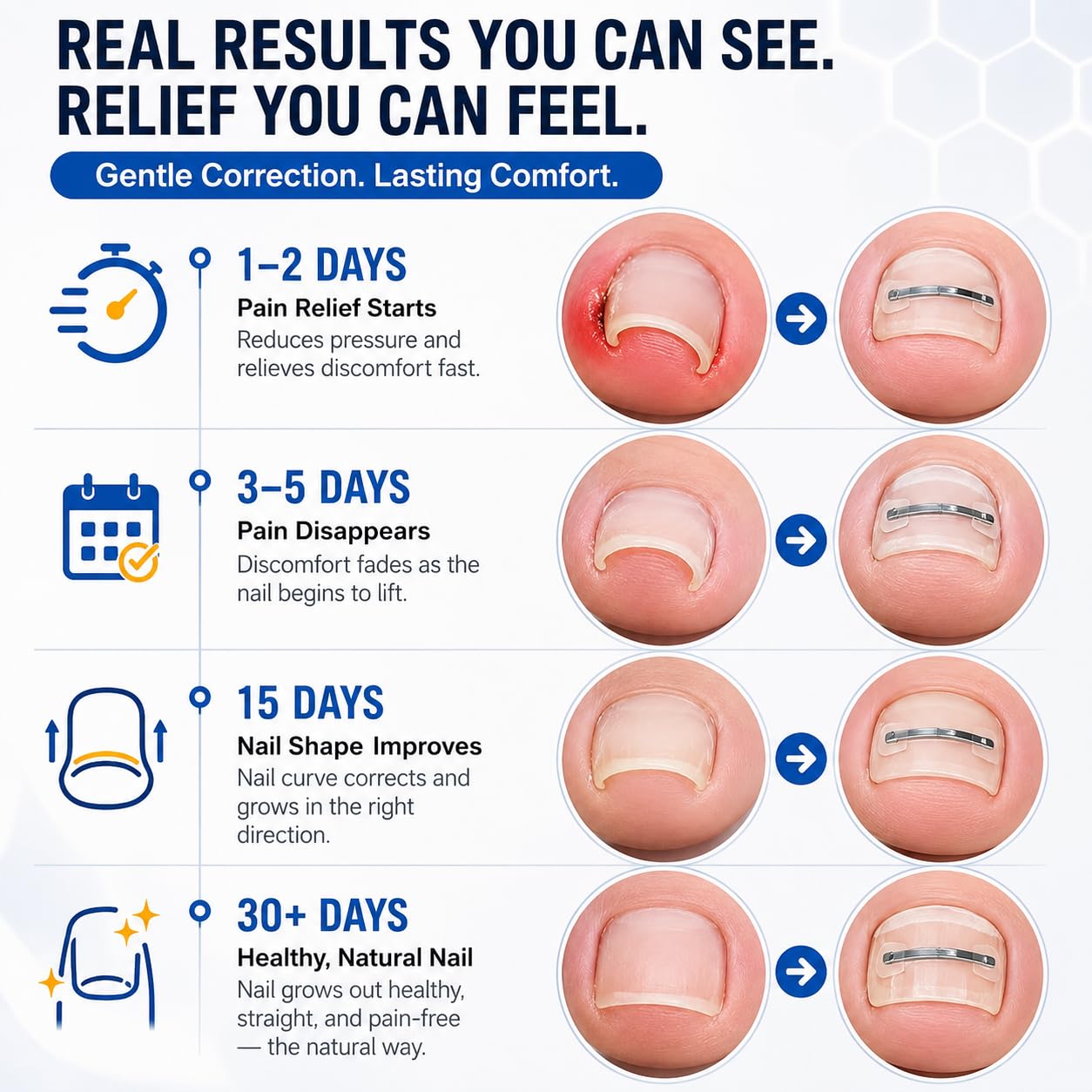MBSOLACE strip applied on toe demonstrating gentle nail lifting support
