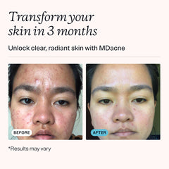 MDacne ingredient display with botanicals demonstrating soothing benefits