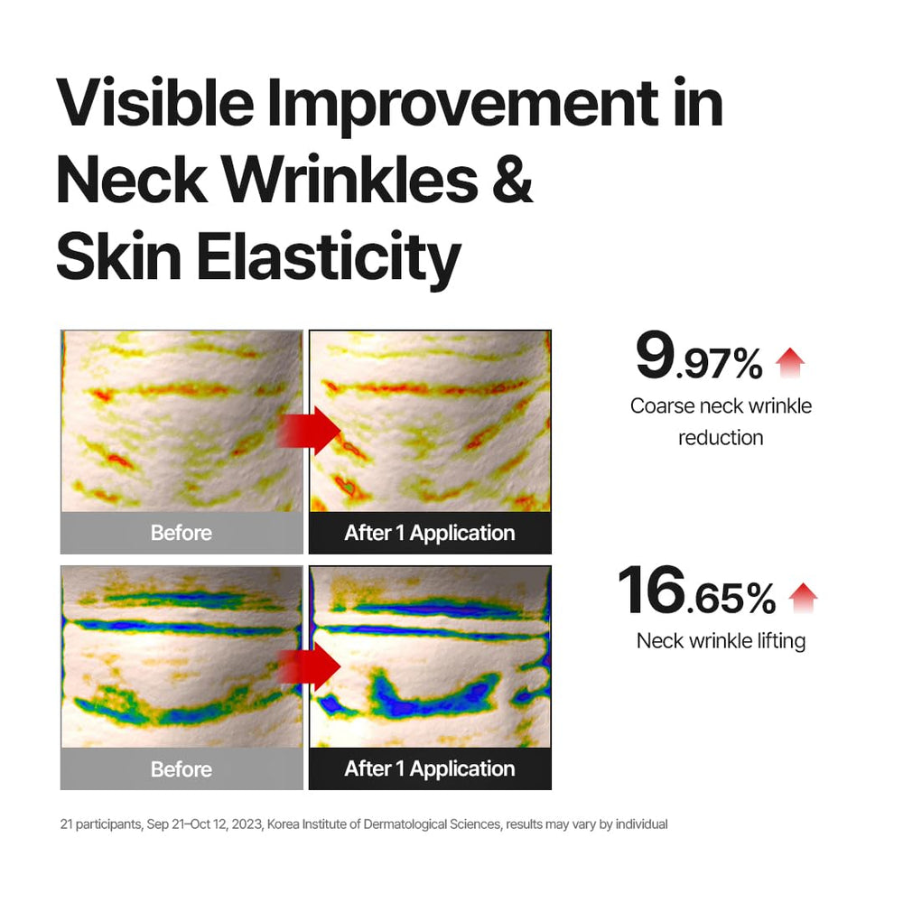 MDP illustrative before and after neck smoothing visual
