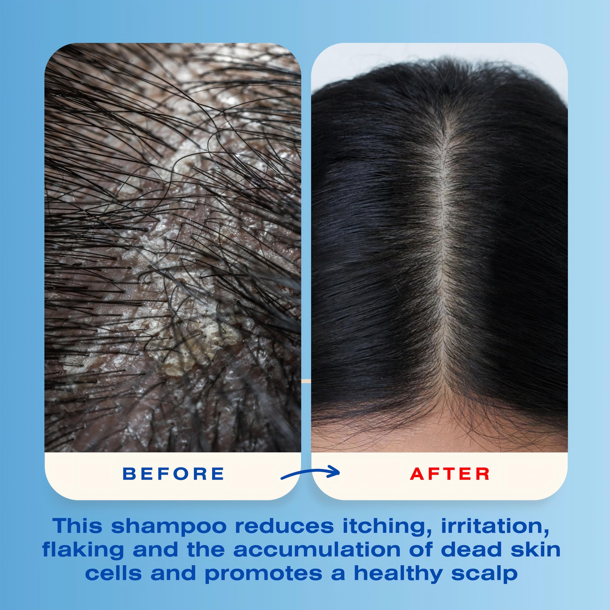 Mediceuticals before and after scalp images showing reduced flakes and calmer skin