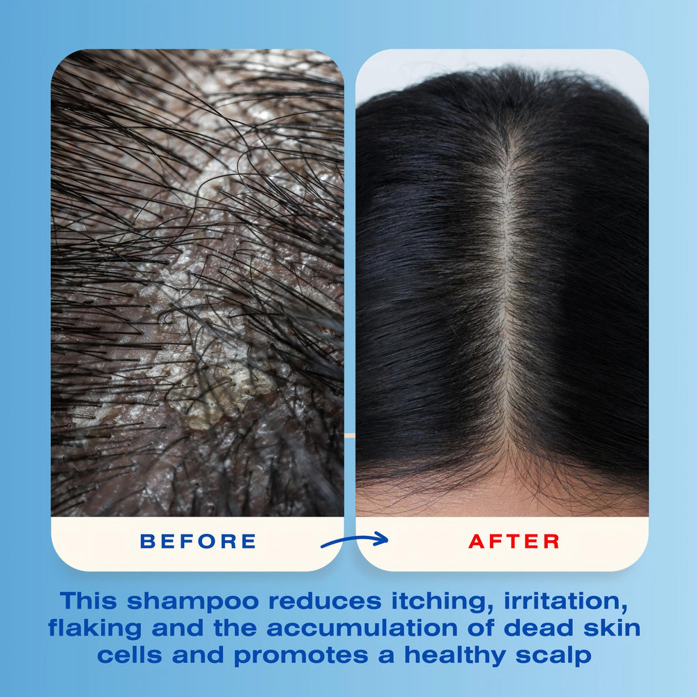 Mediceuticals before and after scalp images showing reduced flakes and calmer skin
