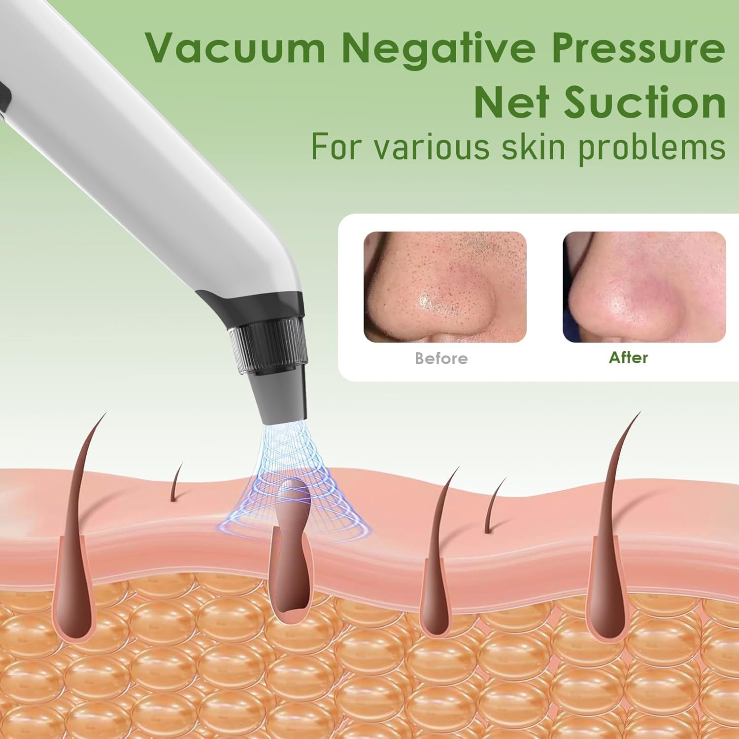 MEDPOAL before and after nose close-up showing reduced visible blackheads and clearer pores