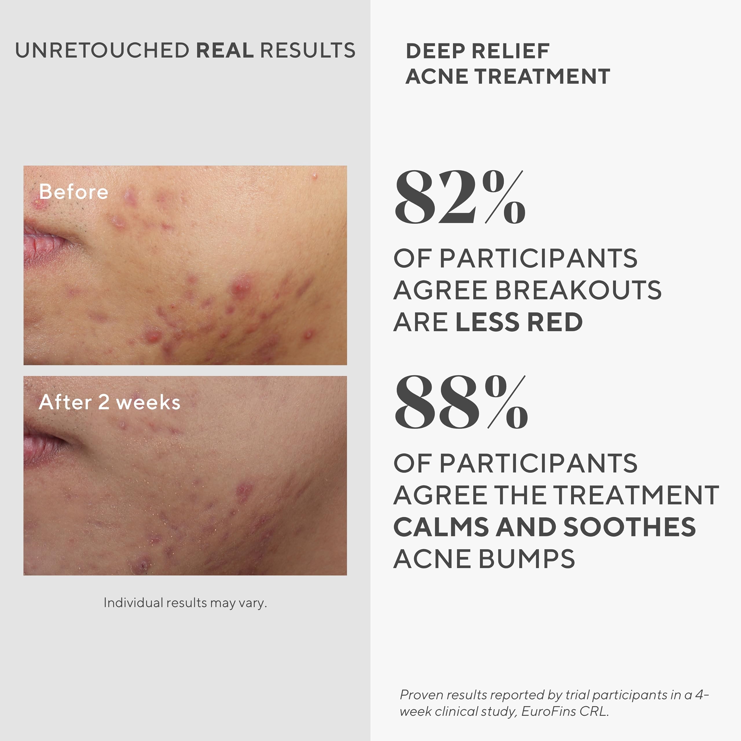 Murad product label showing key ingredients for targeted acne care