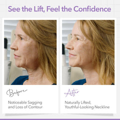 NECK LESS side profile before and after showing defined jawline improvement