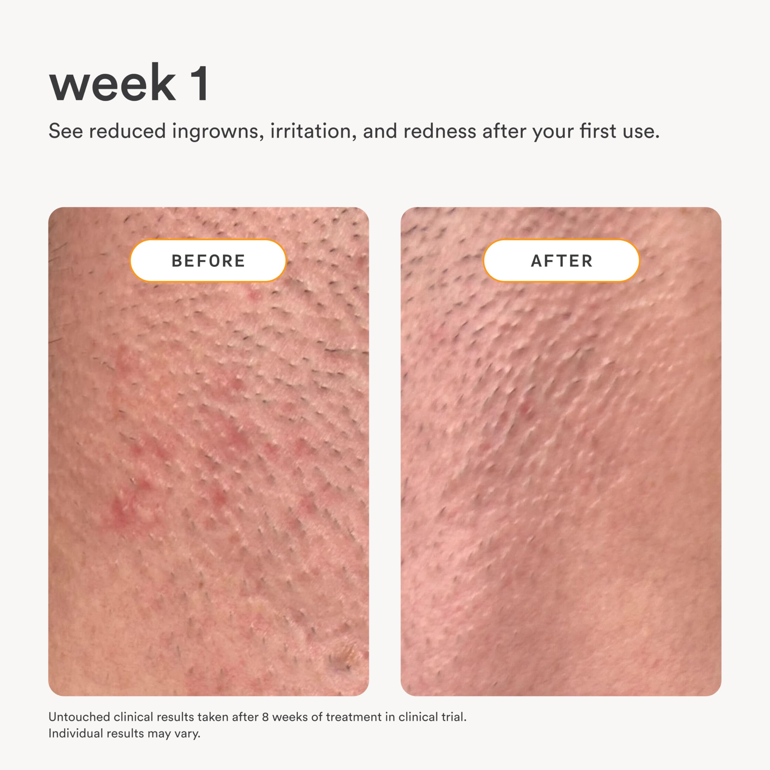 Nood applied to beard area soothing razor irritation