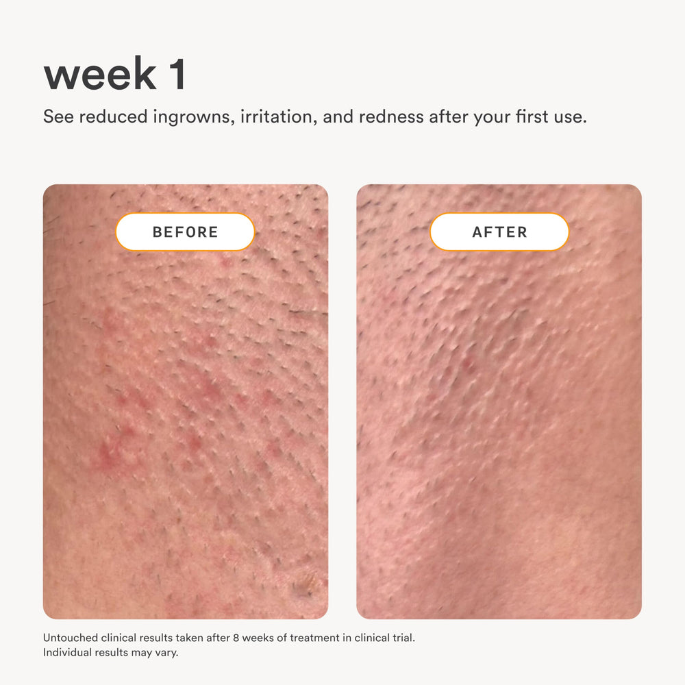 Nood applied to beard area soothing razor irritation